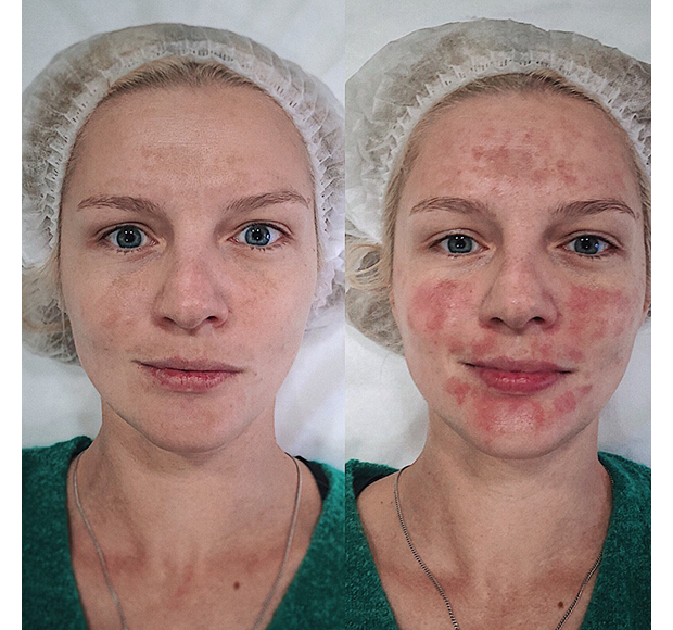 Личный опыт: как привычка загорать вызвала гипер-пигментацию на лице и с помощью чего я решила проблему.